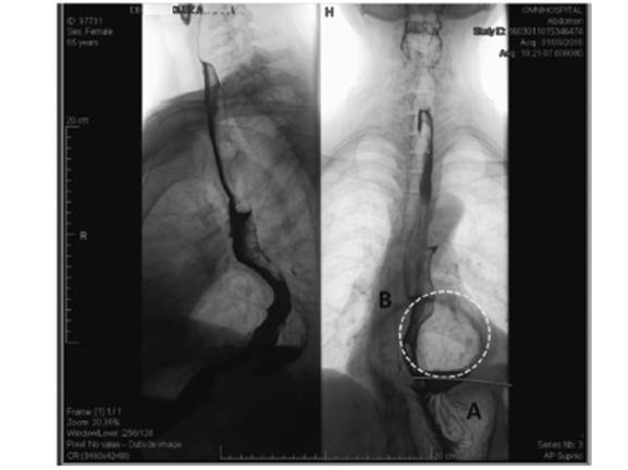 Vista De Hernia Hiatal Un Desaf O Diagn Stico Y Terap Utico A Prop Sito De Un Caso M Dicas Uis