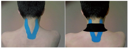 Application of neuromuscular taping with
muscular inhibitory technique Y cut (blue taping), and space technique with I
cut (black taping).