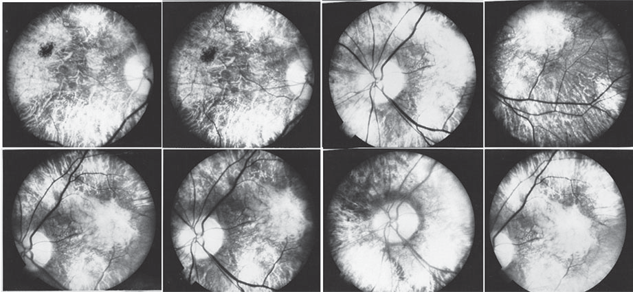Angiografía inicial. Atrofia del epitelio pigmentario de la retina en OD (primera fila de imágenes) que permite la visión de los vasos coroideos y la esclera, atrofia óptica y arterias delgadas, y daño del área macular. En OI (segunda fila de imágenes) hubo hallazgos similares, menos atrofia marcada del EPR y no atrofia óptica. En ambos ojos se aprecia atrofia del EPR, y en el OD presenta hipertrotrofia del EPR superior y temporal a la mácula, con adelgazamiento retiniano que permite apreciar la vasculatura coroidea. En el área macular se observa cambios atróficos y migración pigmentaria generalizada. Además, se observa adelgazamiento del calibre de los vasos retinianos. OD presenta cambios atróficos del nervio óptico y OI nervio óptico sin atrofia.