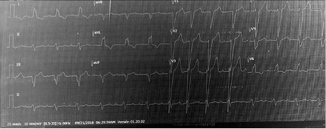 Electrocardiograma basal que evidencia PR prolongado y bloqueo completo de rama izquierda del Haz de His.