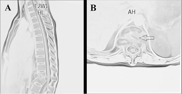 RNM de columna dorsolumbar. Corte sagital (A): fractura patológica con disminución de un 90% de la altura del cuerpo vertebral de T12 y del 10% del cuerpo vertebral de L1 con pérdida de la morfología del disco intervertebral. Corte axial (B): material hiperintenso a nivel de disco intervertebral T12-L1 y colección en el espacio epidural anterior y a nivel de los tejidos blandos para y prevertebrales