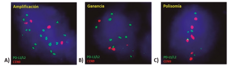 Células de Reed Sternberg/Hodgkin de pacientes con linfoma de Hodgkin clásico hibridadas con la sonda SPEC CD274/PDCD1LG2/CEN9 (locus 9p24.1: verde, centrómero del cromosoma 9: rojo) (ZytoVision, Alemania) mostrando: A) Amplificación del locus 9p24.1; B) Ganancia; C) Polisomía.