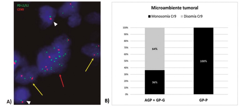 Análisis de los linfocitos pequeños del microambiente tumoral circundantes a las células Reed Sternberg/Hodgkin (RS/H). A)