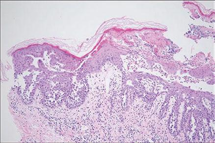 Acantólisis supra basal y hendiduras intraepidermicas en forma de “muro en ruinas”. De Lesión en cara antero-lateral del cuello, (H&E, ×100)