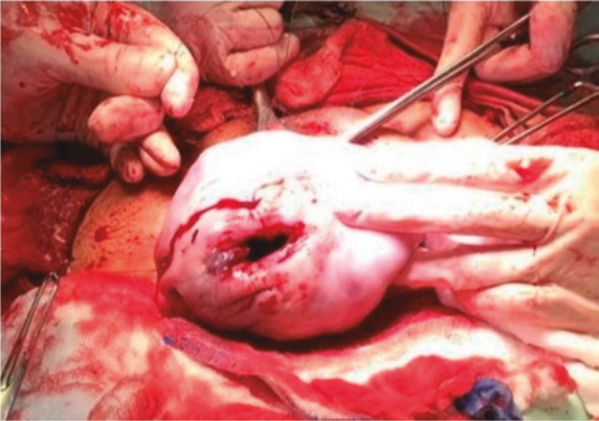Ruptura uterina ubicada en fondo del útero