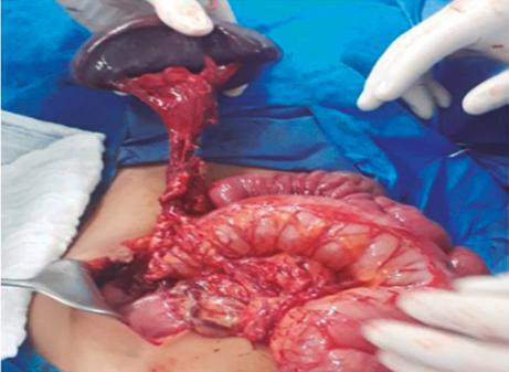 Hallazgo intraoperatorio. Bazo posterior a la detorsión del pedículo vascular, con mejoría de la perfusión del órgano.
