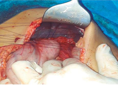 Esplenopexia con suturas de prolene vascular 3-0, entre peritoneo parietal y diafragma.