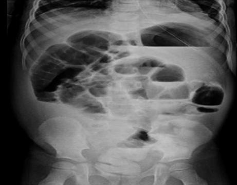 Radiografía de abdomen decúbito supino con hallazgos sugestivos de íleo posquirúrgico.
