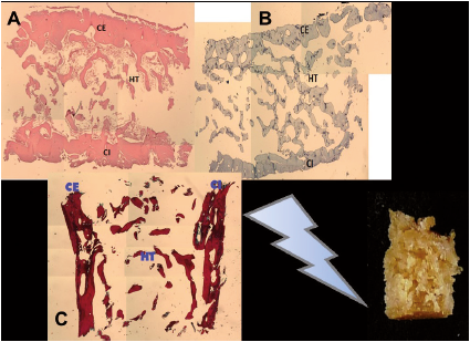In the bottom right biopsy bone is observed. In panel A) there is a compact and trabecular bone slice dyed using H-E, in panel B the bone is dyed using toluidine blue, in panel C) the bone is dyed using Masson trichromico.