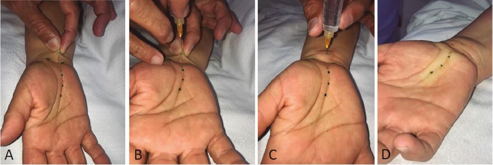 (A) Se levanta la piel entre dos dedos apretándola y pellizcándola suavemente antes de colocar la aguja. (B) Penetración de la aguja perpendicular a la piel, ubicándola debajo de la misma. (C) Inyección lenta de la solución, hasta el volumen previsto. (D) Se observa la zona de anestesia demarcada por la vasoconstricción.